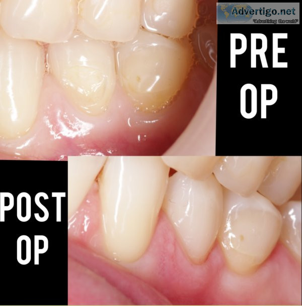 Excellence in tooth-coloured fillings: vanilla smiles dental cli