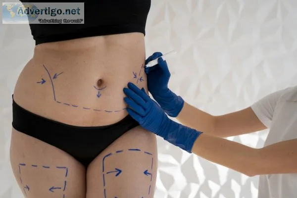 Best liposuction in bangalore | liposuction cost bangalore