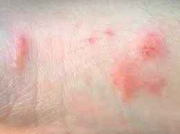 From rash to relief: understanding how long poison ivy lasts