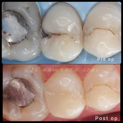 Excellence in tooth-coloured fillings: vanilla smiles dental cli