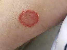 Rapid relief: how to cure ringworm fast