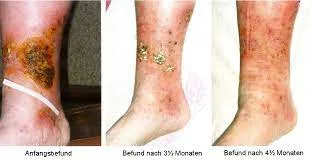 Healing or infected? how to tell if your wound is progressing