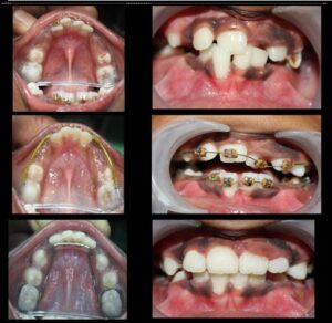 The best orthodontist in pune shivajinagar: vanilla smiles shine