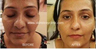 Achieve radiant skin with skin whitening treatment in pune at th