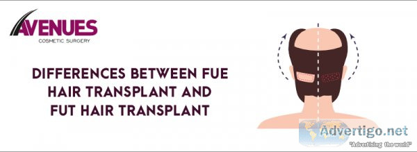Differences between fue and fut hair transplant
