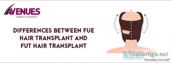Differences between fue and fut hair transplant