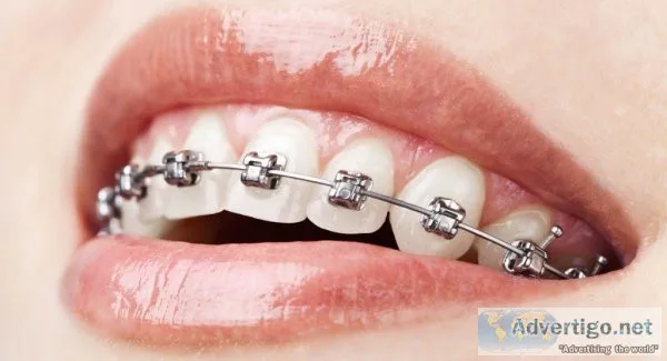 Orthodontic treatment in jogeshwari, mumbai