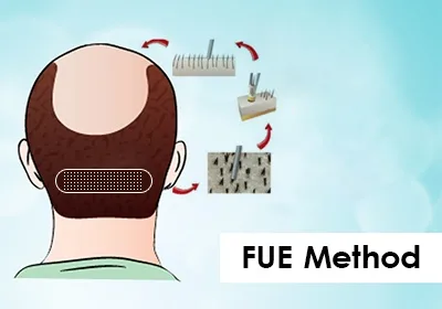 Affordability of fue hair transplants in india