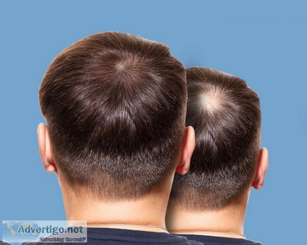 Hair transplant treatment in chennai