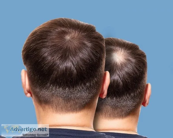 Hair transplant treatment in chennai