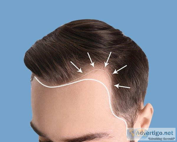 Hair transplant treatment in chennai