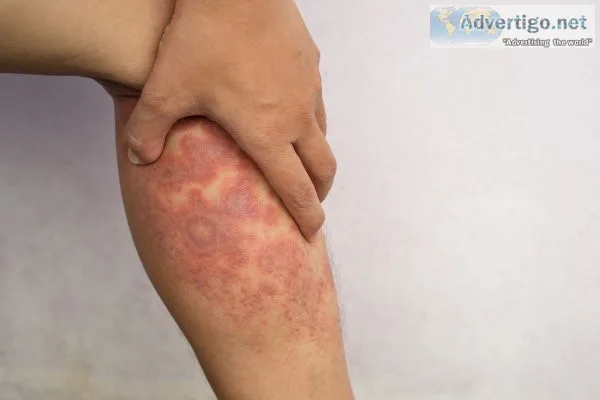 Embrace relief: ayurvedic treatment for eczema