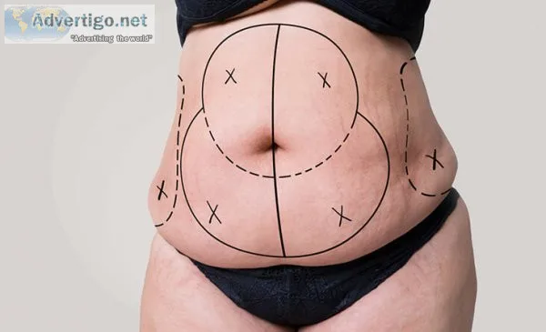 Tummy tuck surgery in delhi | med esthetiks