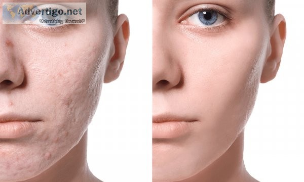 Acne scar removal