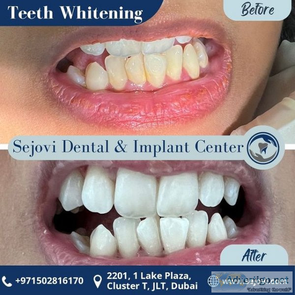 Dubai teeth whitening