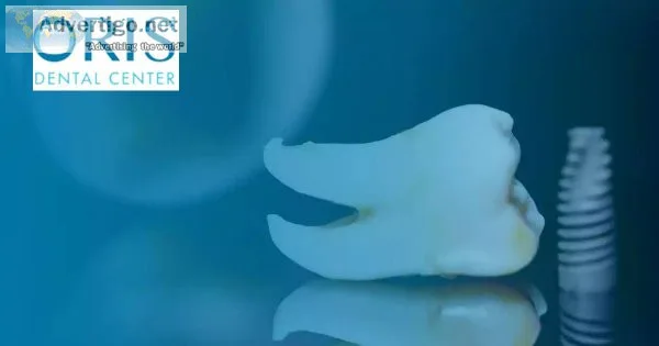 Wisdom tooth extraction in dubai | wisdom tooth pain treatment- 