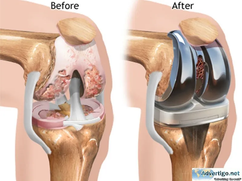 Best knee replacement surgery doctor in noida