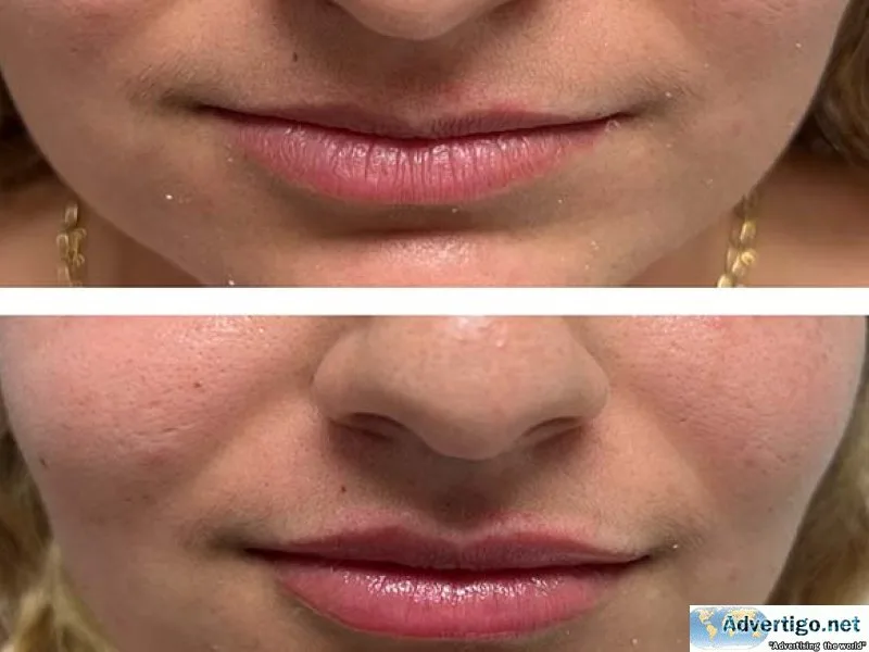 Get the best lip fillers in riverside, ca