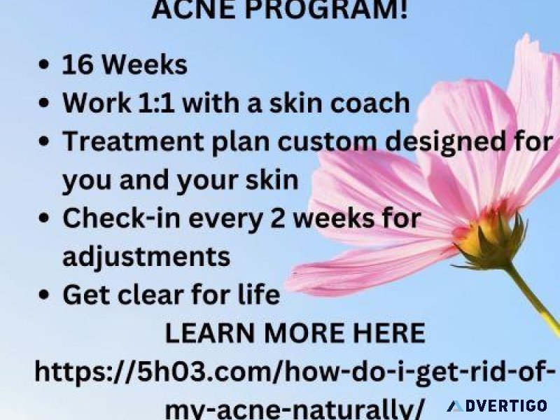How do i get rid of my acne naturally