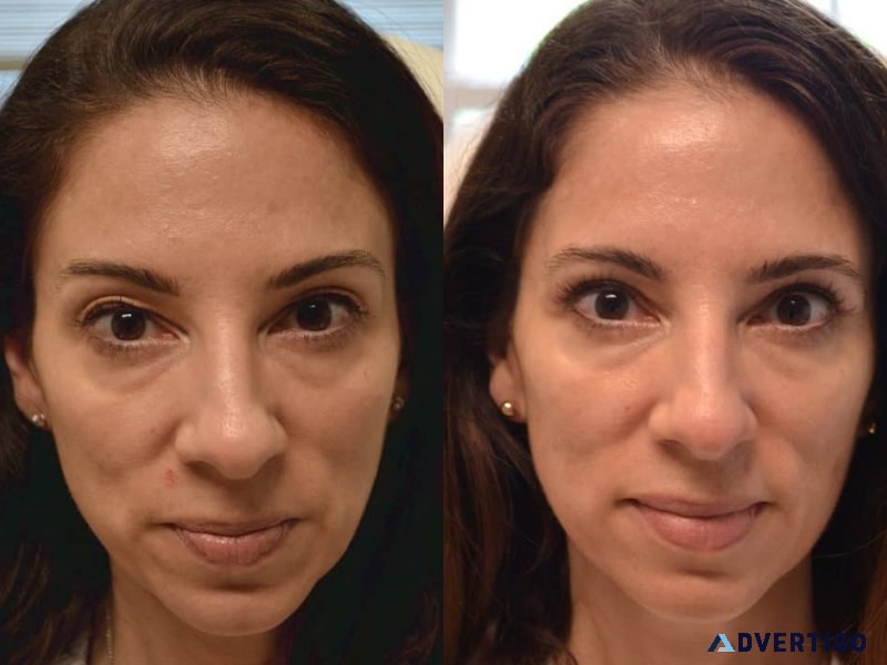 Baggy eyelid surgery
