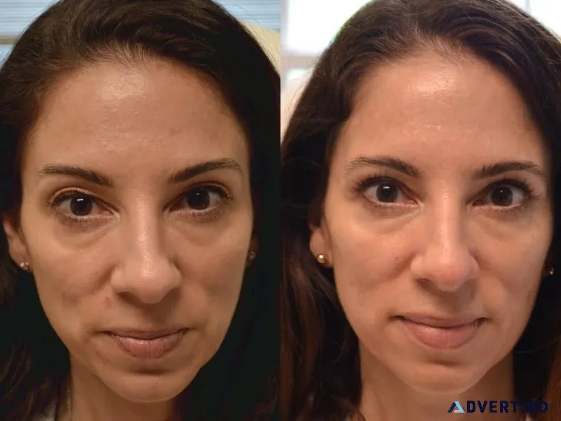 Baggy eyelid surgery