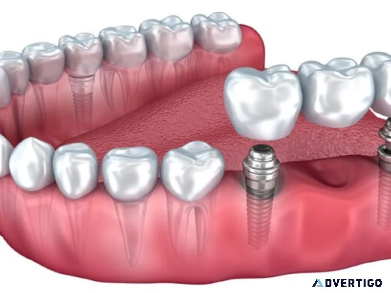Genuine cost of dental implants in gurgaon
