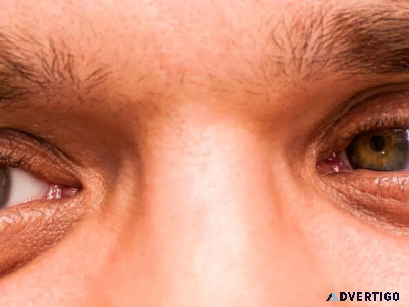 The best squint eyes treatment in delhi, india