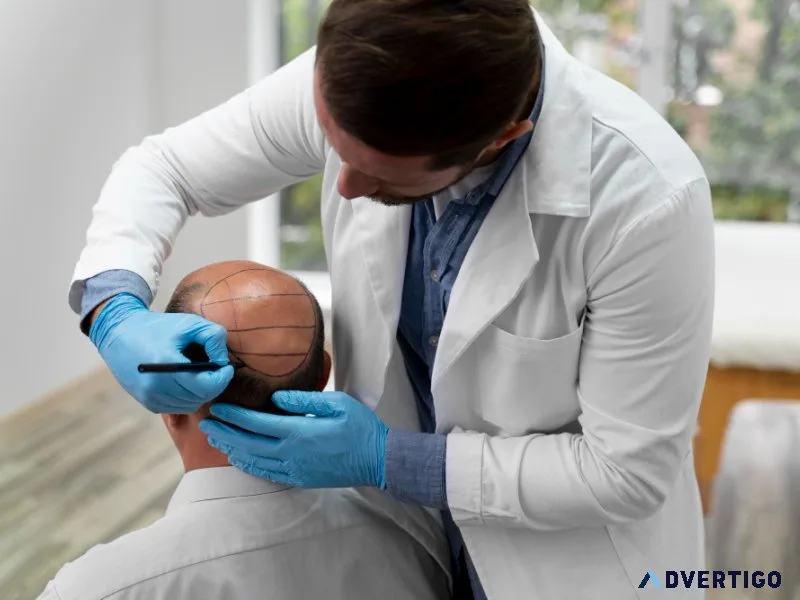 Best hair transplant in delhi