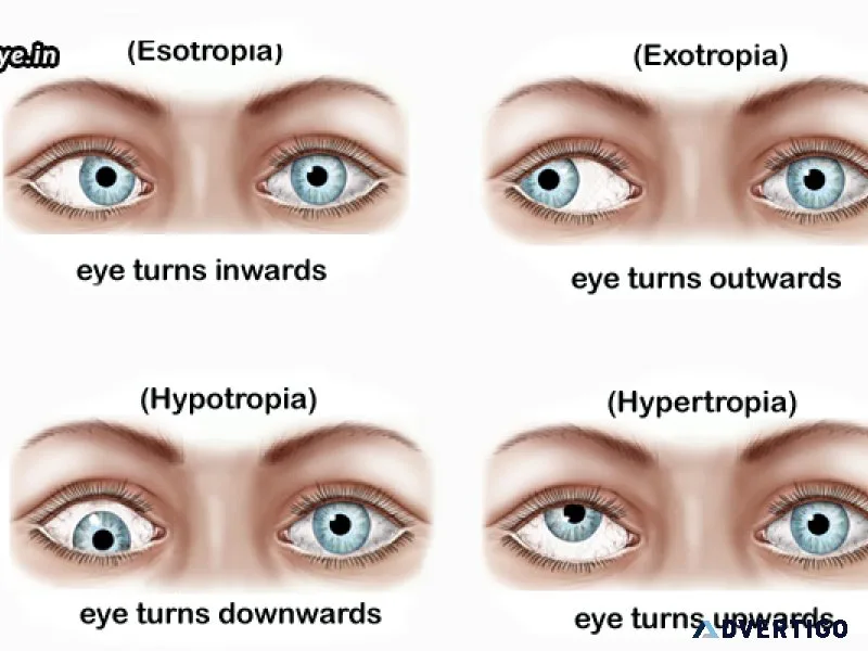 Best squint in eyes treatment available in delhi