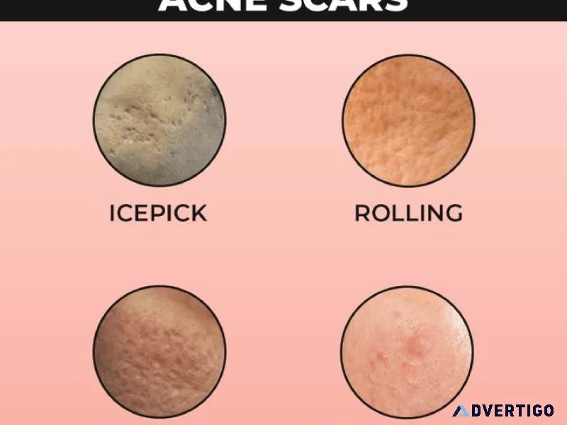 Acne scar treatment cost in hyderabad