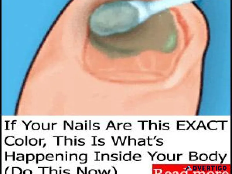 How To Clear Nail Fungus 3X Faster Even While Sleeping