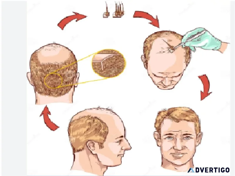 Hair transplantation in prayagraj , uttar pradesh