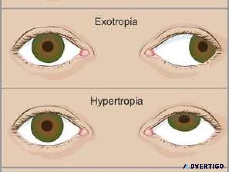 Top hospital for squint in eyes treatment in delhi