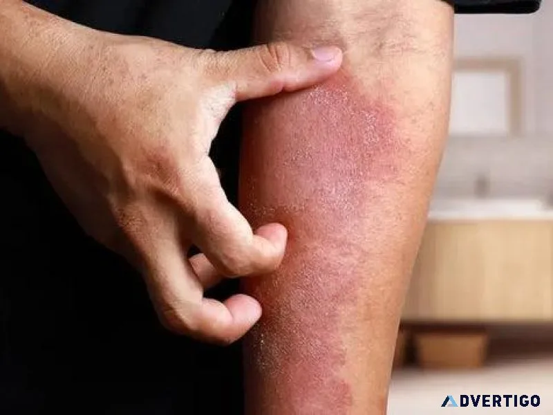 Revitol Dermis Psoriasis Cream