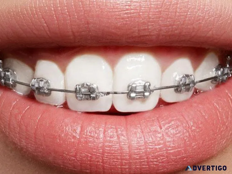 what are power chains for braces