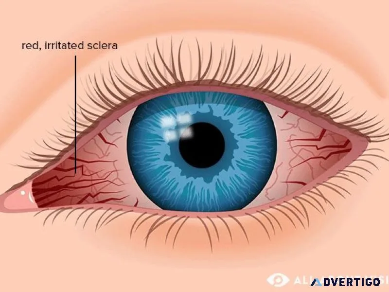 Best eye hospital for red eye treatment in delhi
