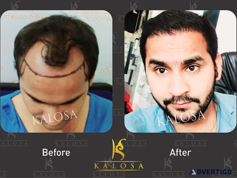 Elevate your beauty: female hair transplant