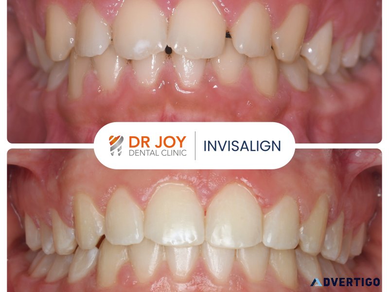 Invisalign in dubai