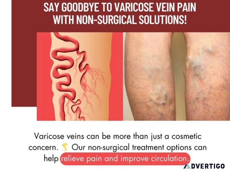 Best varicose veins hospital in hyderabad