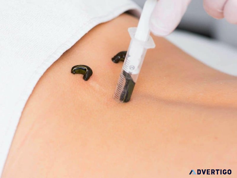 Leech therapy treatment in ghaziabad