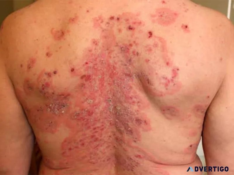 Find lasting relief from sarcoidosis with proven ayurvedic herbs