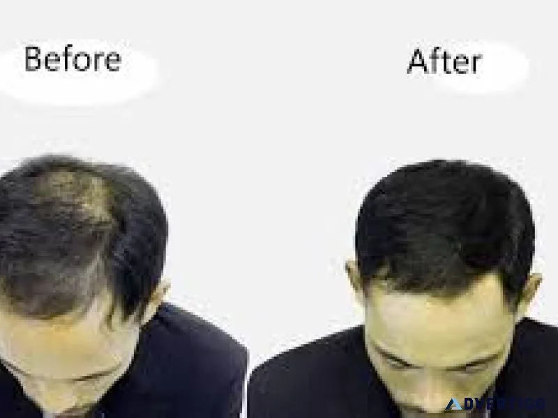 Hair transplant surgery in nashik