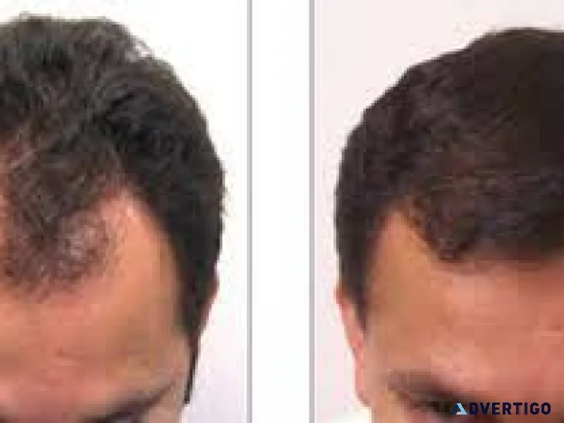 Hair transplant clinic in bangalore