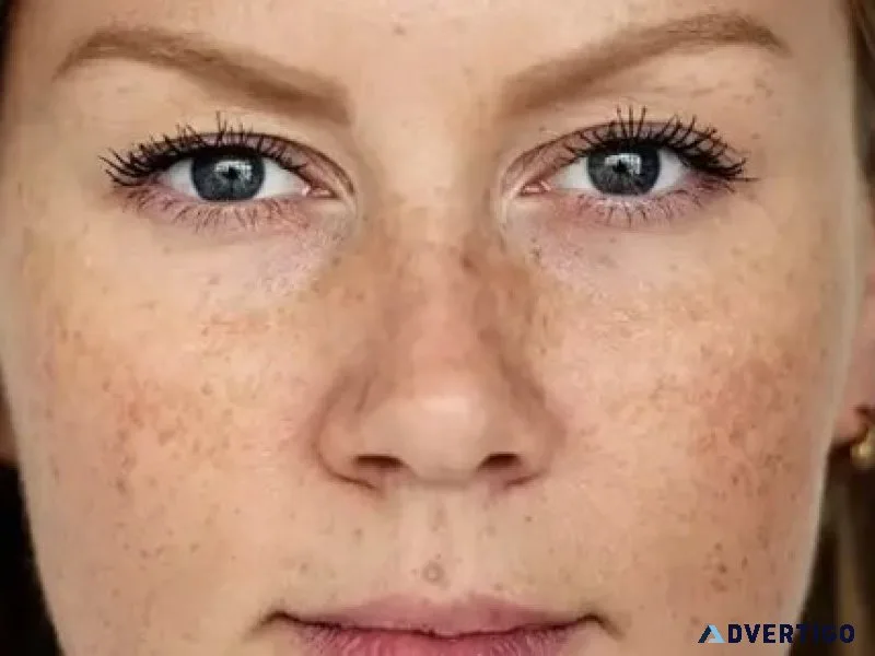 Pigmentation treatment in ludhiana