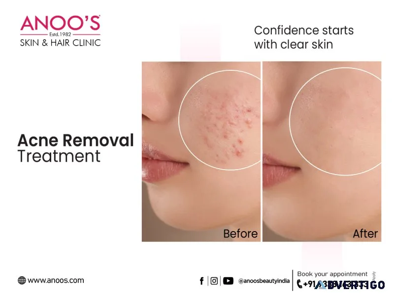 Advanced acne removal treatment at anoos