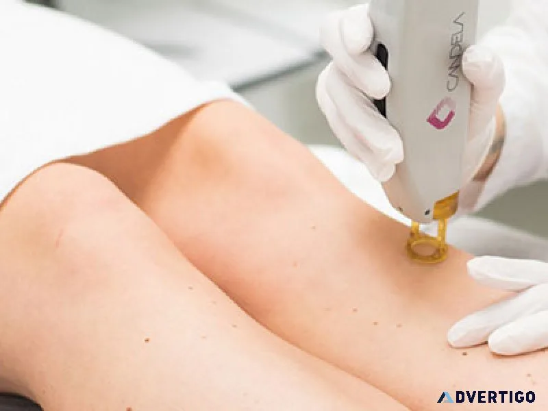 Grace and glamour: best hair removal in gurgaon