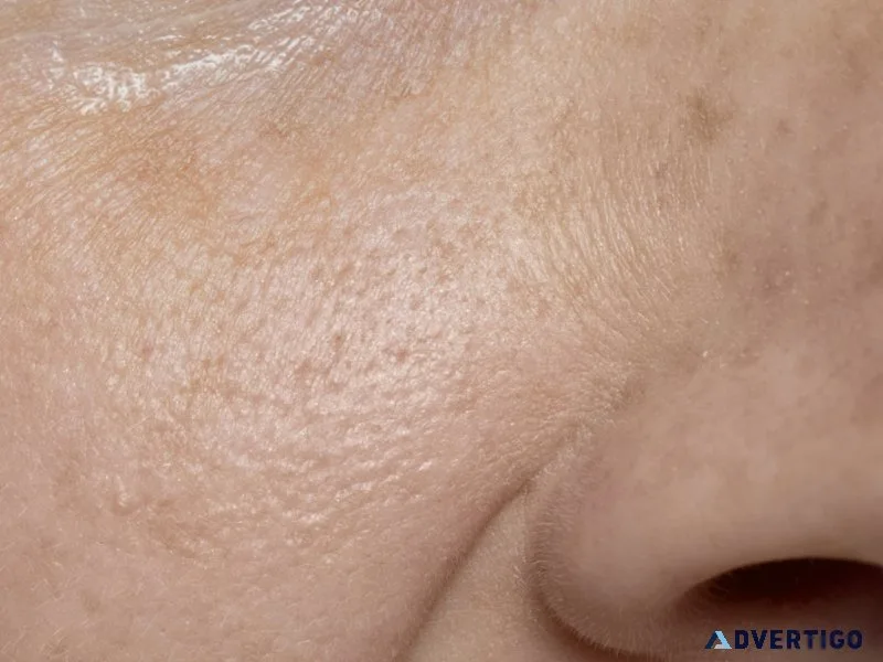 Open pores treatment in ludhiana