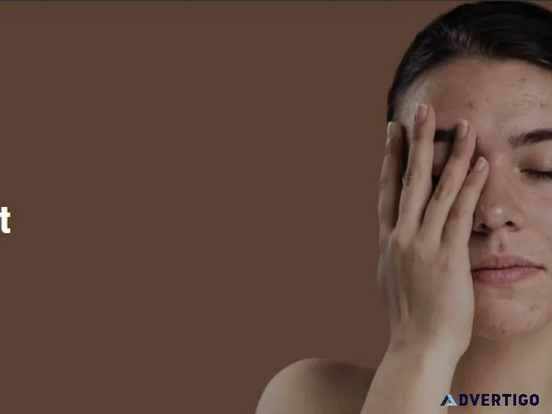 Acne scar treatment in south delhi- skination clinic