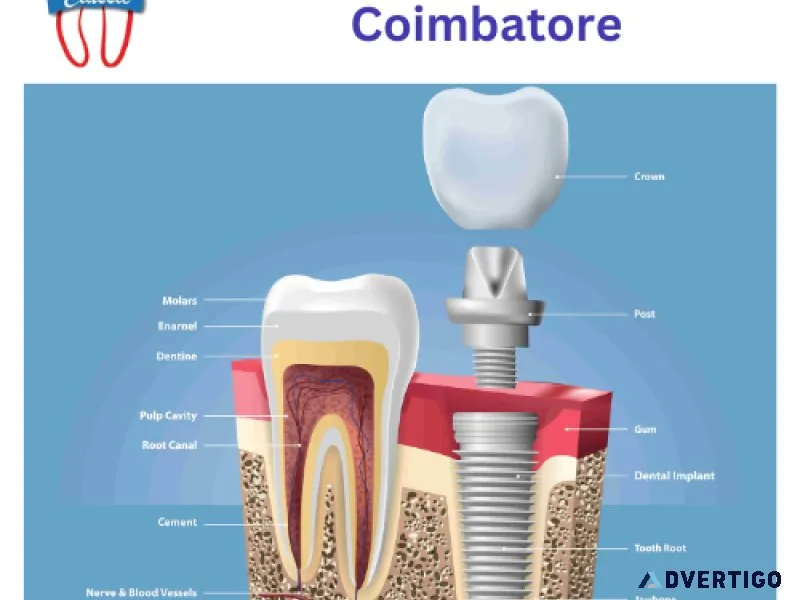 Dental implants in coimbatore | implant dentistry coimbatore