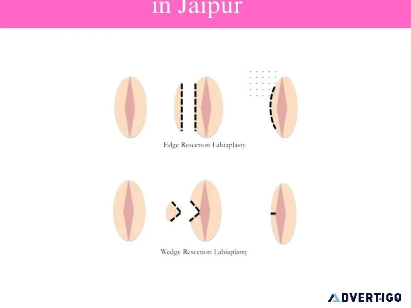 Premier labiaplasty clinic in jaipur